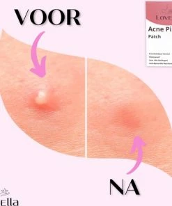 Lovella Pimple Patch 216 Stuks, Acne Patch, Acne Pleister, Pimple Patches, Puisten Verwijderaar, Puisten Pleister, Hydrocolloïd -Chanel Shop 550x537 1