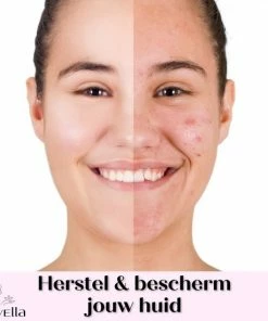 Lovella Pimple Patch 216 Stuks, Acne Patch, Acne Pleister, Pimple Patches, Puisten Verwijderaar, Puisten Pleister, Hydrocolloïd -Chanel Shop 550x550 116